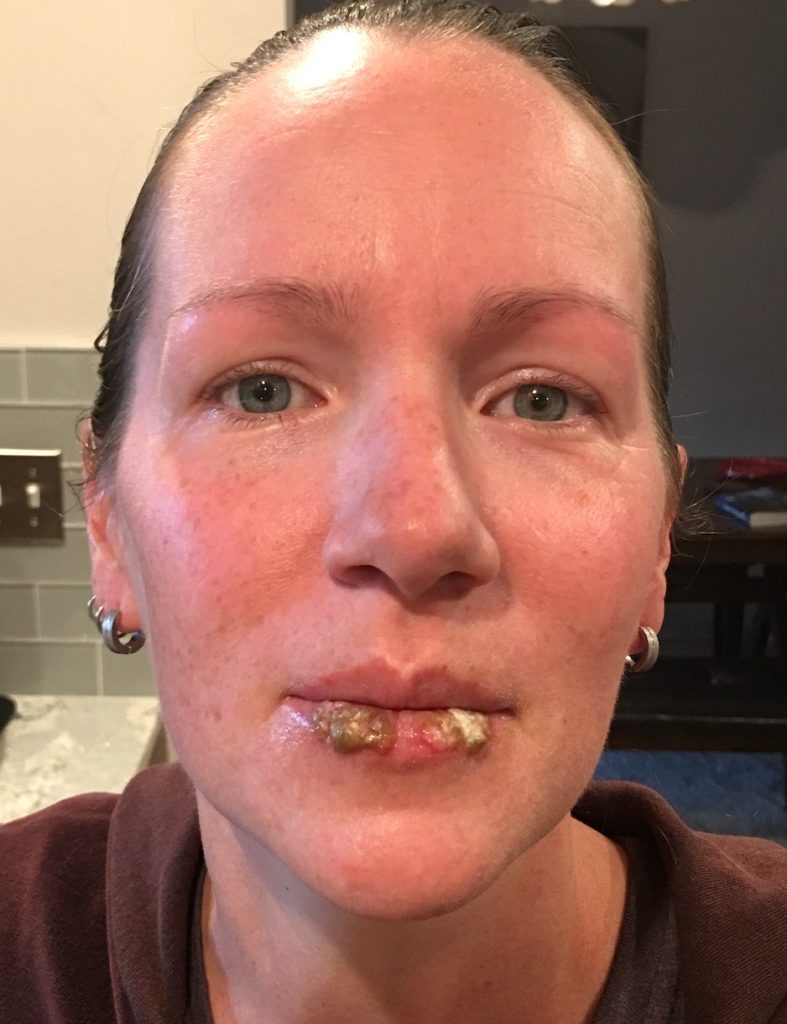 Mrs. ItchyFeet with lip bacterial infection