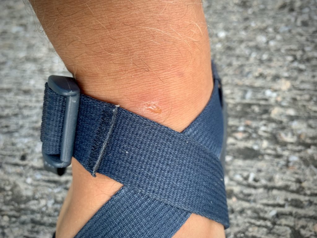 Nasty ant sting on ankle