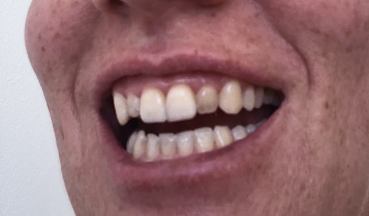 Mrs. ItchyFeet's teeth turning grey