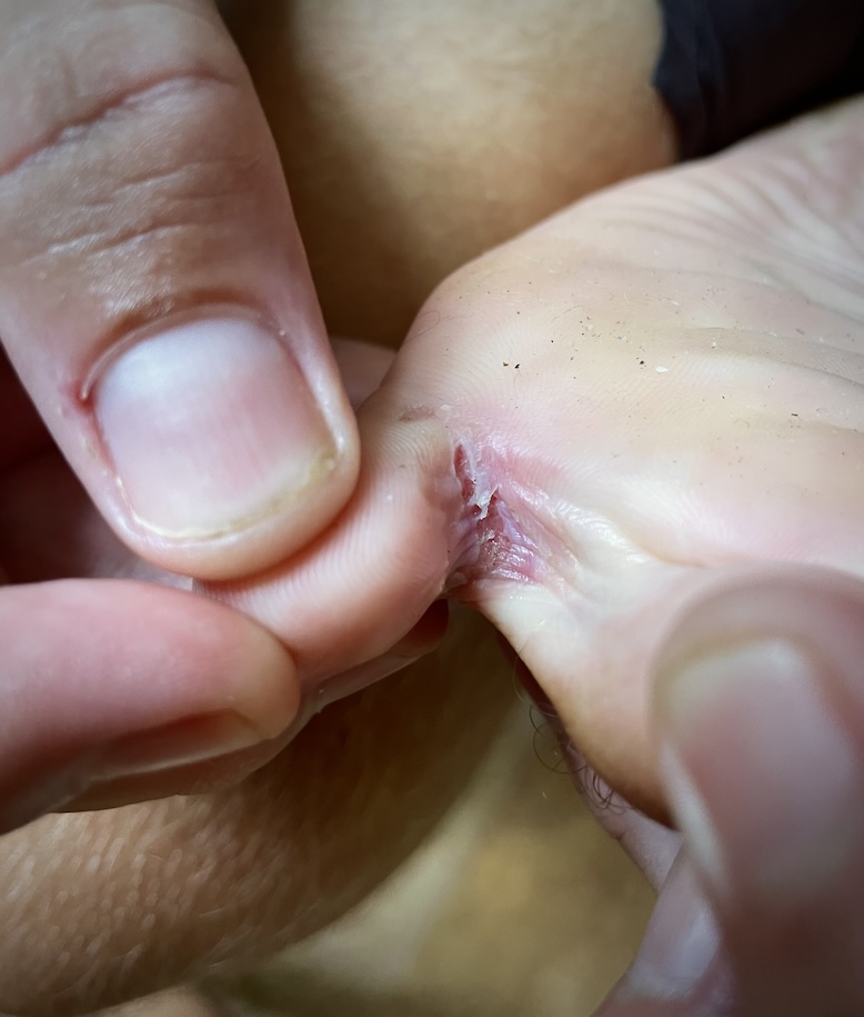 Fungal infection between toes