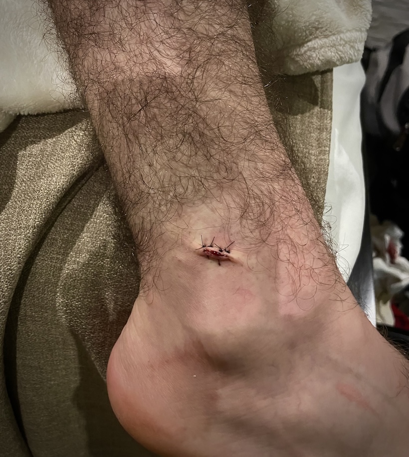 Ankle with stitches